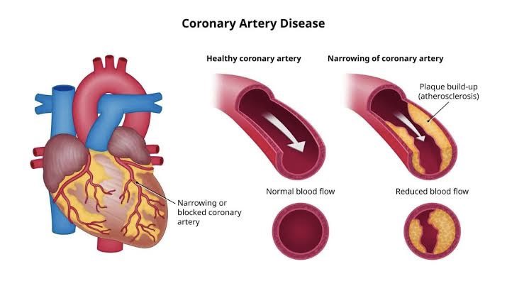 heart conditions to pregnancy. It is even more dangerous than High BP. 𝐂𝐨𝐫𝐨𝐧𝐚𝐫𝐲 𝐀𝐫𝐭𝐞𝐫𝐲 𝐃𝐢𝐬𝐞𝐚𝐬𝐞 (𝐂𝐀𝐃)/ 𝐀𝐭𝐡𝐞𝐫𝐨𝐬𝐜𝐥𝐞𝐫𝐨𝐬𝐢𝐬- It affects the coronary artery, blockage of coronary artery due to deposition of cholesterol, Calcium, fibrous- 6/