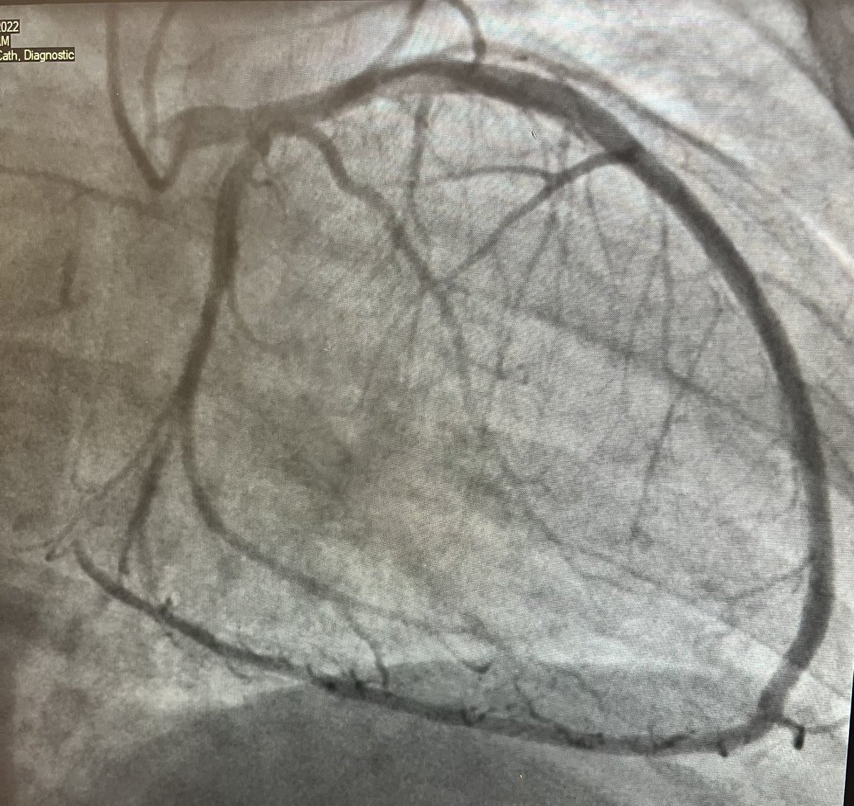 If you had to use these septals for 🏄‍♂️ would it be called antegrade or retrograde? 

#CardioTwitter