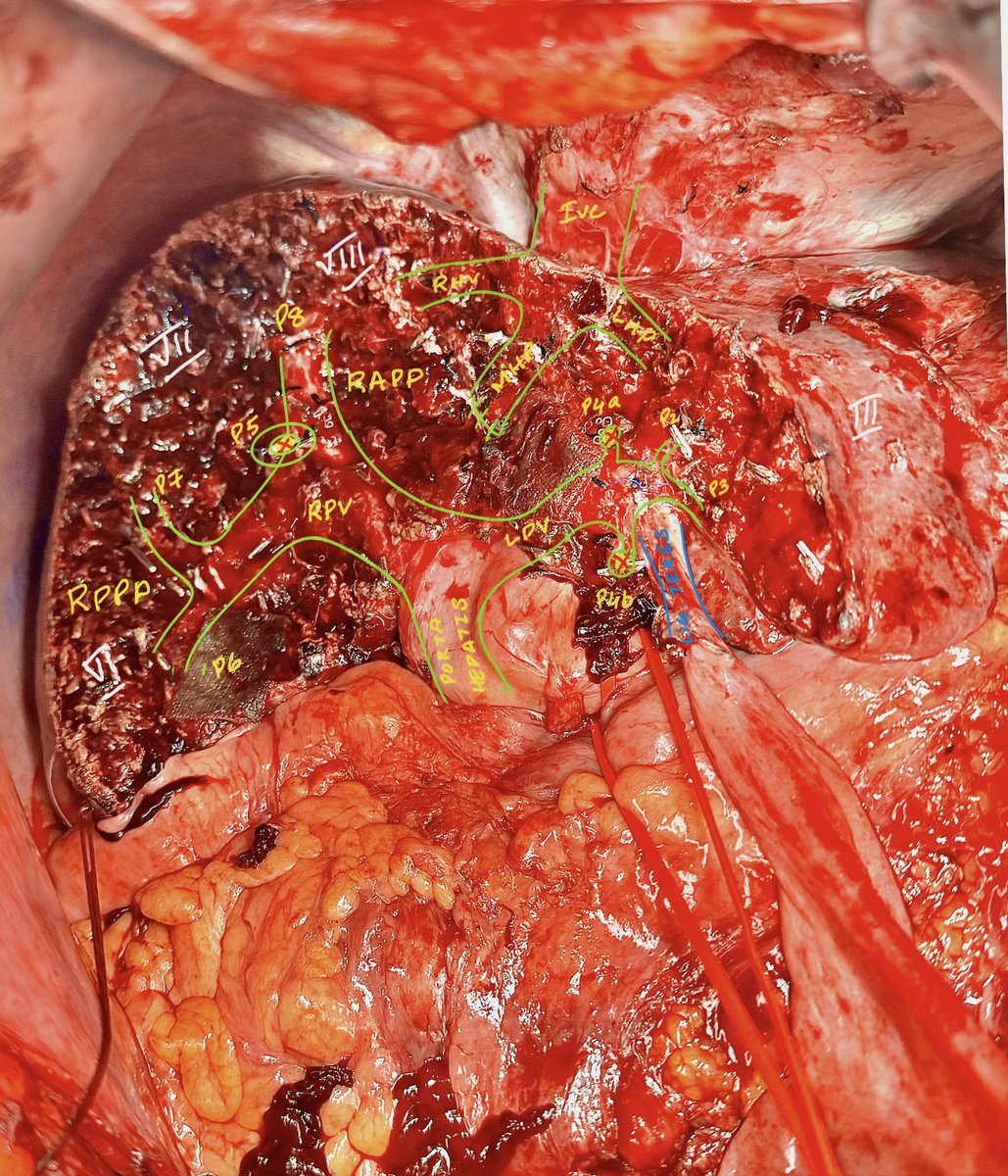 AsadAzim's tweet photo. Way to do text book central hepatectomy with @JCastellanos_MD @lkwiner86 
Beautiful Anatomy #HPB #Liver https://t.co/bCMZS6Rr9v