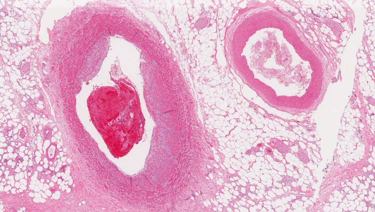 Happy New Year to all! January #COTM is now available on our website. A 43 yo M underwent total proctocolectomy with 1 y h/o diarrhea usgips.com/resources/case… #pathology #GIpath