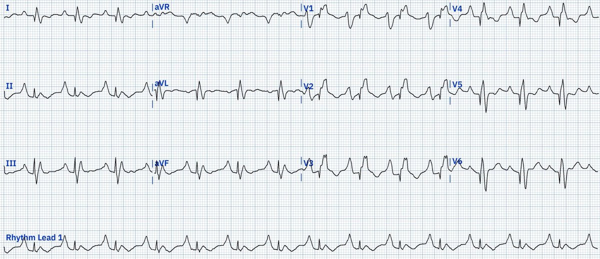 Anomalía de Ebstein
ECG característico:
🫀Onda P gigante en "Himalaya"⛰️
🫀BRD con q Inicial: por gran dilatación de Aurícula derecha
🫀 QRS fragmentado
🫀Taquicardica sinusal compensando un bajo VS