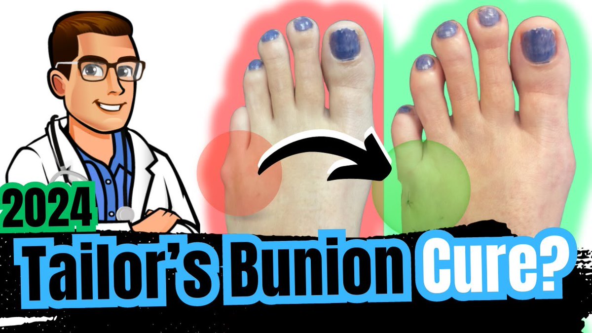 Bunionette Tailor's Bunion Surgery? [Corrector, Splints & Treatment]
youtu.be/ysDlRbs45fg

#podiatry #podiatrist #foothealth #health #footwear #bunionette #tailorsbunion #bunion #bunionpainrelief #buniontreatment #footpain