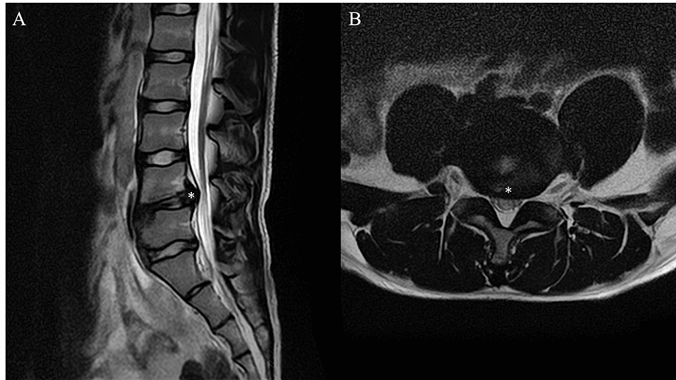 CureusMedical's tweet photo. A fascinating case report on ultrasound-guided lumbar intradiscal injections, now published on our platform! @Toru_Omodani
Check it out here: https://t.co/4KRmI30Jr9 #PainManagement #UltrasoundTechnology #MedicalCaseReport #InnovativeHealthcare #MinimallyInvasive #Cureus https://t.co/99FJOP9umJ