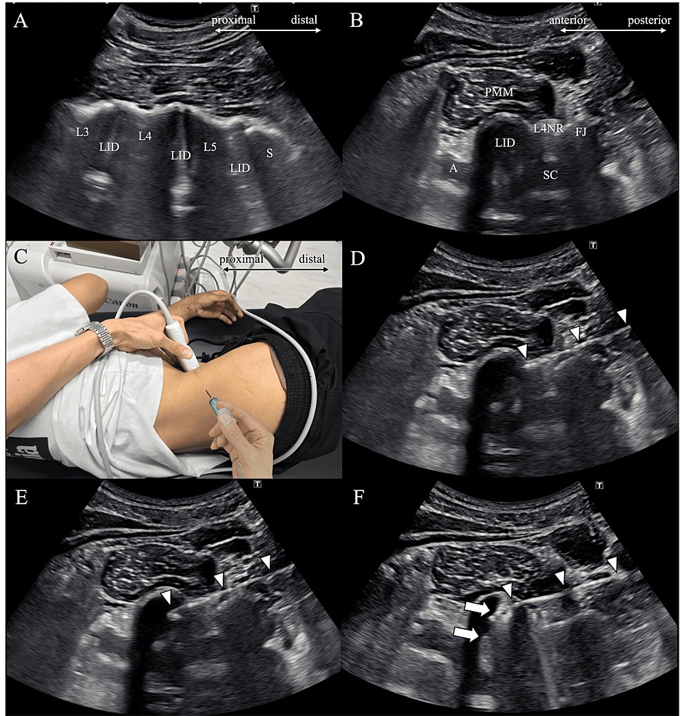 CureusMedical's tweet photo. A fascinating case report on ultrasound-guided lumbar intradiscal injections, now published on our platform! @Toru_Omodani
Check it out here: https://t.co/4KRmI30Jr9 #PainManagement #UltrasoundTechnology #MedicalCaseReport #InnovativeHealthcare #MinimallyInvasive #Cureus https://t.co/99FJOP9umJ