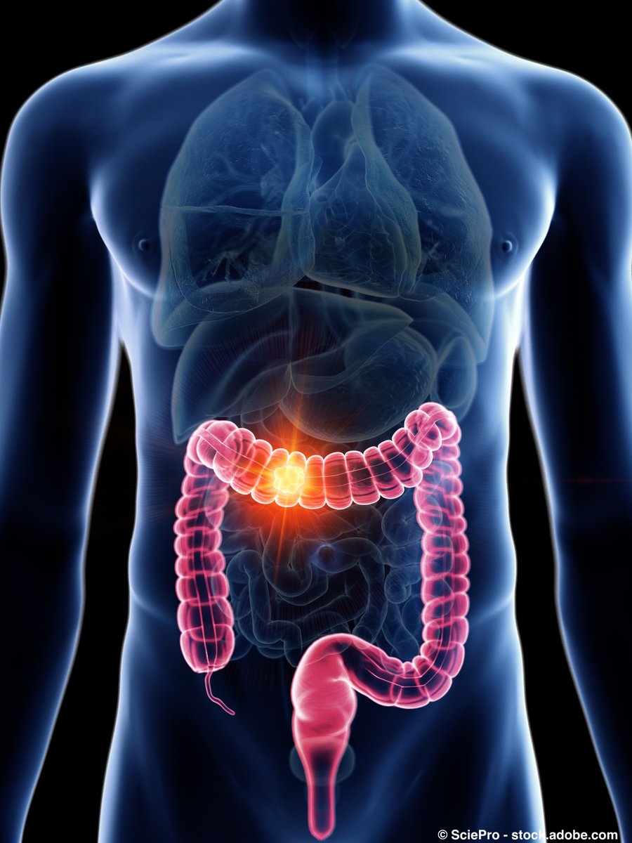 OncLive's tweet image. According to findings from the first interim analysis of the observational BESPOKE study, MRD detection by ctDNA was predictive of disease recurrence and response to adjuvant chemotherapy in pts with CRC. @pashtoonkasi #crcsm #GI24 onclive.com/view/ctdna-is-…