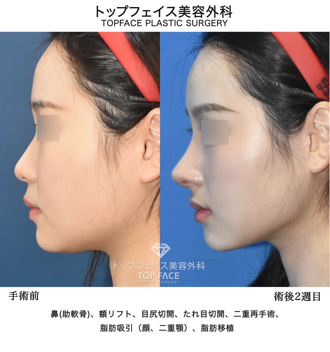 topfacejp's tweet photo. まんまるとした童顔がコンプレックスという20代前半女性。
韓国や中国のインフルエンサーのような華やかな雰囲気を希望されましたので、額・前顎の脂肪移植で立体感を与え、鼻は肋軟骨で高く派手につくりました。
また顔の脂肪吸引、額リフト、目の再手術では涼しげで大きな目をつくり、希望されていたような派手でお人形さんのような美貌を手に入れられた方です。

🇯🇵トップフェイスの東京相談会🇯🇵
前回大好評だった東京相談会が戻ってくる！！
2024年2月24日~2月25日に開催されます🥰

 ※本相談会は2024年 6月30日までの手術希望者を対象に行われる相談会です。
それ以降でお考えの方は次回の相談会の際に申請をお願いいたします。

✅申請方法✅
１，トップフェイス公式LINEに

”2月の東京相談会申請フォーム
申請者の氏名（本名：ローマ字）”
とお送りください。

２，メッセージの確認が出来次第、担当
者が申請フォームをお送りいたします🌟

✅予約、相談は日本公式ラインへ➡https://t.co/dtnUhvY8iy
🇯🇵日本語スタッフ院内常駐

✅症例写真：https://t.co/aGmzZmD4wF

#トップフェイス美容外科 #韓国整形 #整形 #イケメン #アイドル #美容整形 #美容垢さんと繋がりたい
#美容クリニック