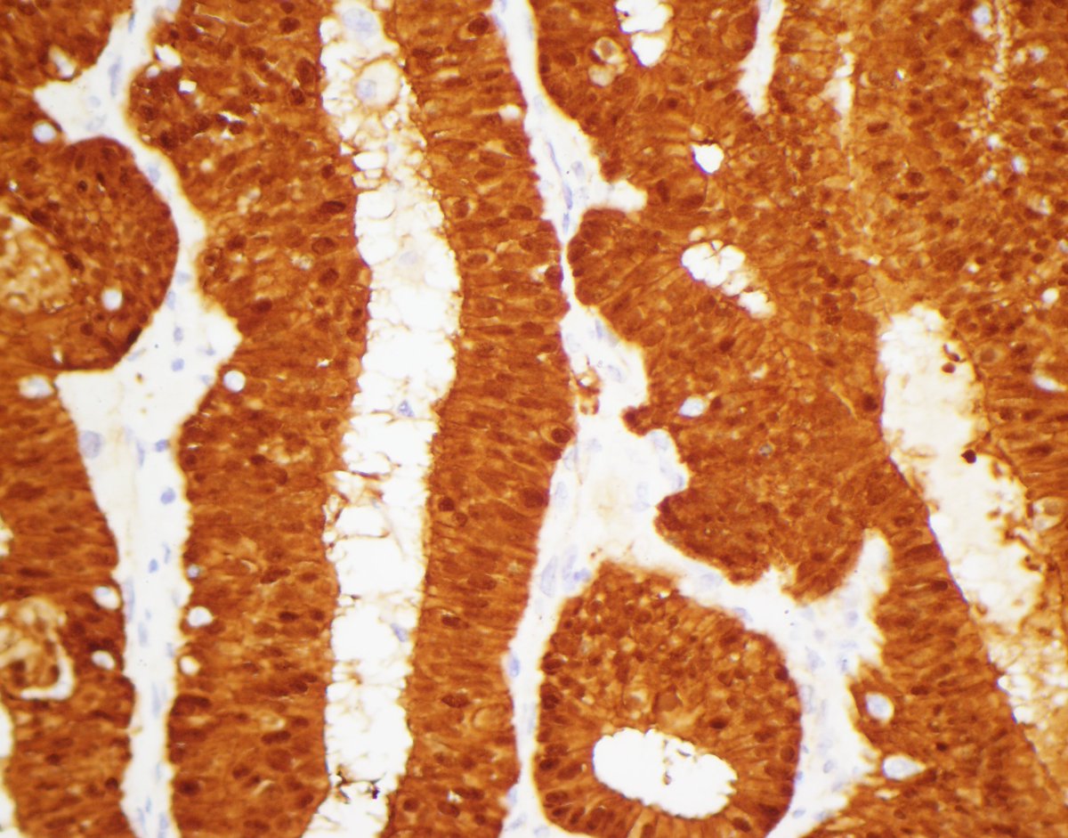 CaDxPath's tweet image. Here's a good practice tip for pathologists.

If you encounter a thyroid carcinoma in a young person that you think at low power must be PTC, but at high power the nuclear features aren't quite right (but also not quite wrong) for this diagnosis, there are a couple of staining I…