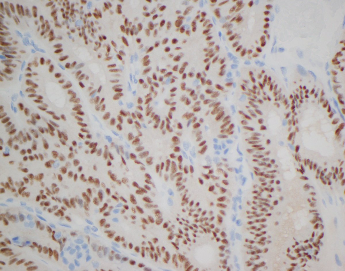 Here's a good practice tip for pathologists. If you encounter a thyroid carcinoma in a young person that you think at low power must be PTC, but at high power the nuclear features aren't quite right (but also not quite wrong) for this diagnosis, there are a couple of staining I…