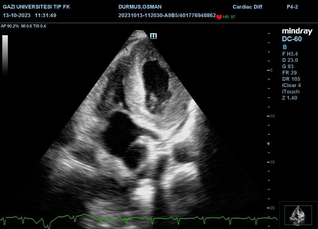 drozant1's tweet photo. Male, 60s cre 0,7 to 1,4, protenuria 1,5 gr/day, ED+ had cor angio last month normal coronaries
ECHO diagnostic just at a glance, even w/o the best windows
Normal EF does not exclude HF!!!
#sonation #pocus #echofirst #echocardiogram #nephrology @smirioglu @ilayberke https://t.co/W39CiqbU7K