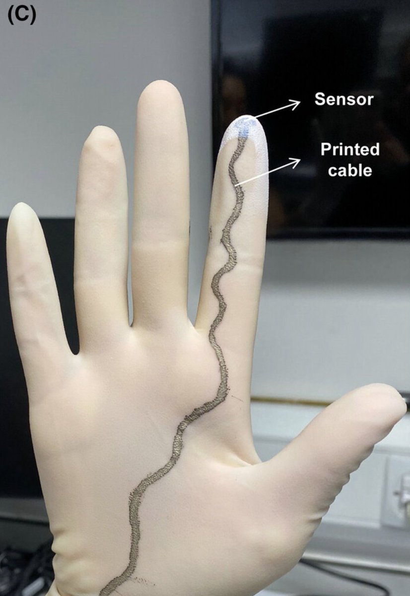 A cheap-to-manufacture sensorised glove can accurately detect anal sphincter injuries. obgyn.onlinelibrary.wiley.com/doi/full/10.11…