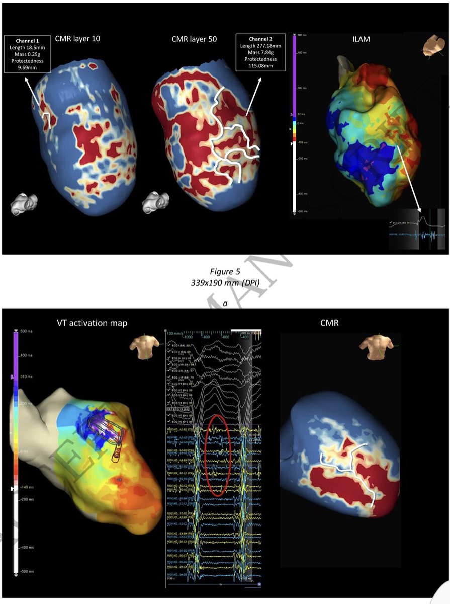 Noninvasive Detection of Slow Conduction with Cardiac Magnetic Resonance Imaging for VT Ablation!#Epeeps doi.org/10.1093/europa…