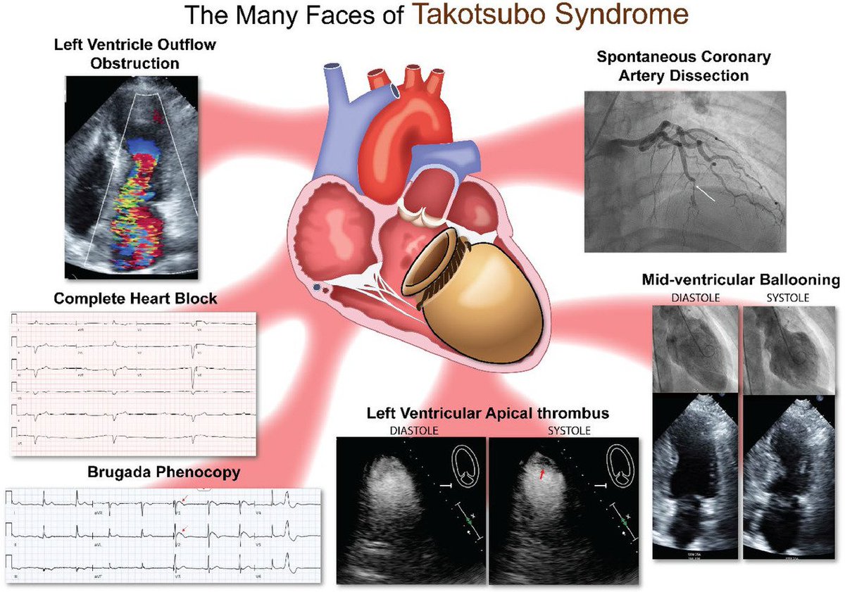 #JADEL I remain fascinated by Takotsubo - a syndrome needing to be studied more to better understand mechanisms as a means for future treatment options! Congratulations @TahaAhmedMD & Peter on your recent publication: authors.elsevier.com/c/1iUO9XGgSeOvS @GillKentucky @UK_HealthCare