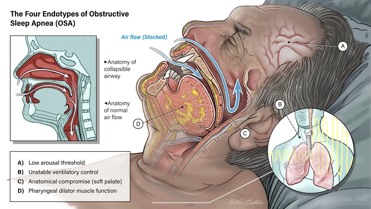 Obstructive Sleep Apnea: Pathophysiology and Endotypes @healwj2 @atulmalhotra13 @DrBobOwens @SanchezAzofra Click here to learn about the Obstructive Sleep Apnea endotypes 🔗 bit.ly/48ArdzY