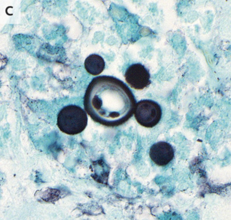 TakaMatsuo_ID's tweet photo. 【Paracoccidioidomycosis】@NEJM Jan 25, 2024
👉Pilot's wheel:
Spherical thick-walled yeast cells of variable size, with peripheral buds protruding from a central cell
https://t.co/AFmmr6IRUG
#IDFellow #IDMedEd #IDBoard @MSG_ERC @DrFungus_MSGERC https://t.co/5eTEa5zp0R