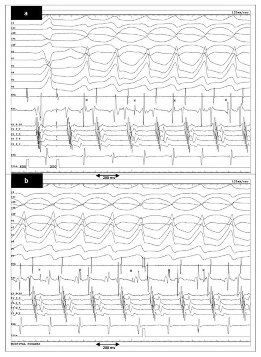 🔥 Hot of Press in <a href="/JICE_EP/">JICE</a> 🔥 

“Duodromic tachycardia in #WPW using 2 septal APs in close anatomical proximity with visible His Bundle dissociation”

Amazing case &amp; EGMs done w/EP team <a href="/GusCostaEP57/">Gustavo Costa</a>  <a href="/Speranzaric/">Dr. Ricardo Speranza.</a>  <a href="/KamilaOlivera13/">Kamila Olivera</a> at <a href="/hospitalposadas/">Hospital Posadas</a>

doi.org/10.1007/s10840…