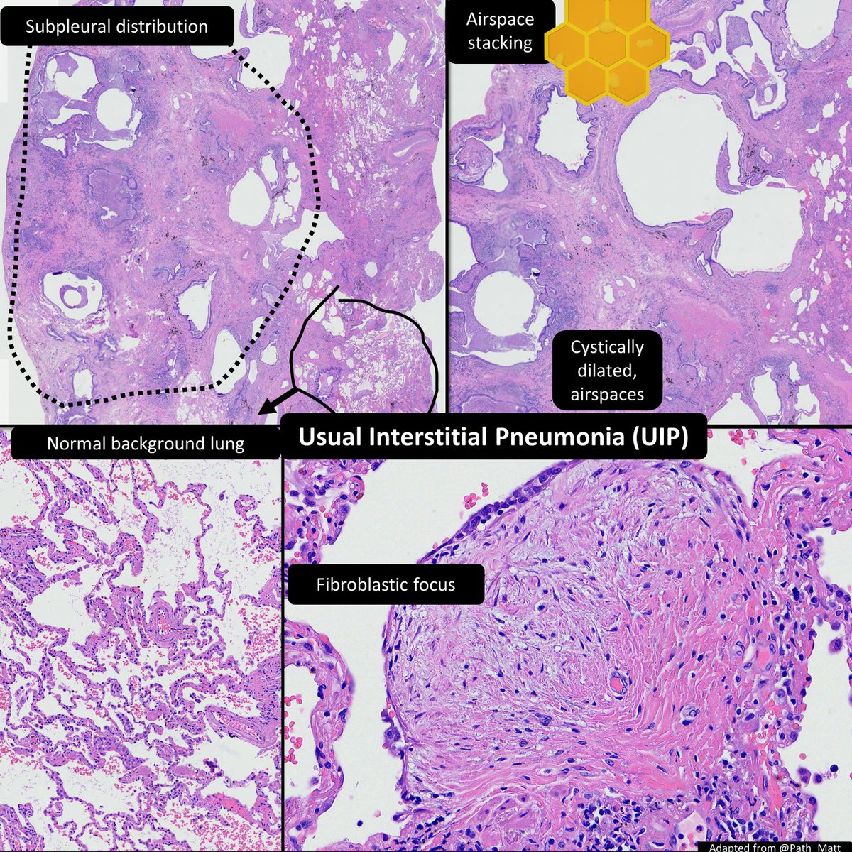 DrCycloPath's tweet photo. UIP: temporally heterogenous, fibroblastic foci, subpleural
🔬https://t.co/YexL5D3oyc
OP: temporally uniform, fibroblastic plugs, peribronchiolar
🔬https://t.co/ut0WYmaUcF
DAD: prototype morphology of acute lung injury; exudative phase has max edema ~1 day after injury, hyaline membranes ~3 days; organizing phase follows
🔬https://t.co/Zk9BPBsBVt
#PulmPath #PathResidents #PathTwitter
WSI🙏@Path_Matt