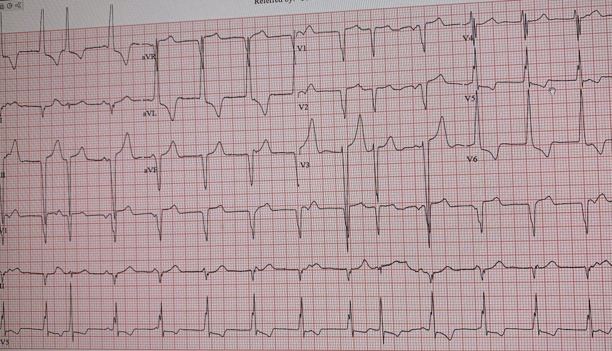 A1Cardiology's tweet photo. 70 year old male who is currently asymptomatic.

What is going on ?

#cardiotwitter #ST4CardiologyInterview
#EPeeps https://t.co/QhMoLUyxsE