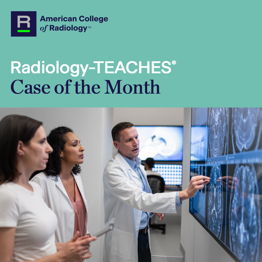 RadiologyACR's tweet photo. #RadTEACHES Case of the Month (1/2 🧵)  A 65-year-old woman presents with symptoms of heaviness and bulging in the pelvis. The patient has a history of multiparity and had a hysterectomy performed several years ago. You are suspicious for pelvic organ prolapse. https://t.co/xgIag5USlf