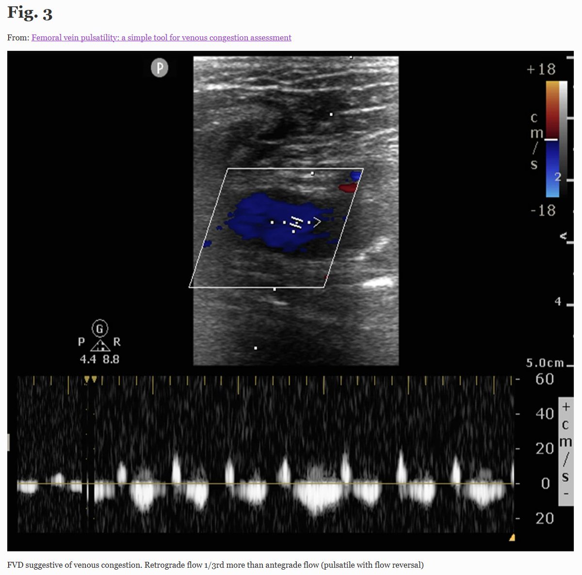 Is this new slick technique the new kid on the block of venous assessment? Promising and fast, so why not? theultrasoundjournal.springeropen.com/articles/10.11…
