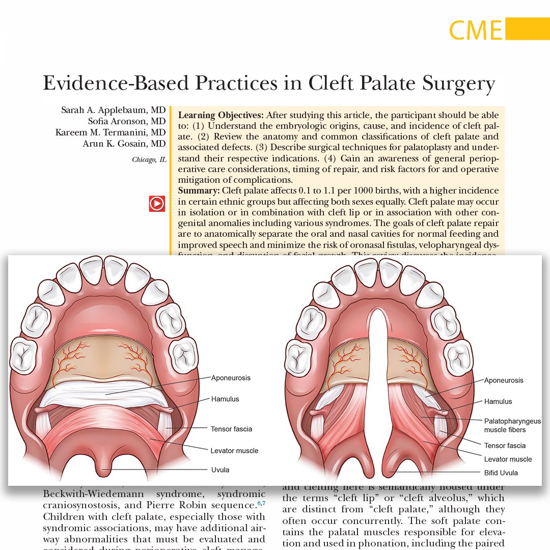 Interested in understanding the embryologic origins, cause, and incidence of #cleftpalate? Want to learn about the #anatomy and common classifications of cleft palate and associated defects and more? Check out this #CME article: bit.ly/EvidenceBasedC…