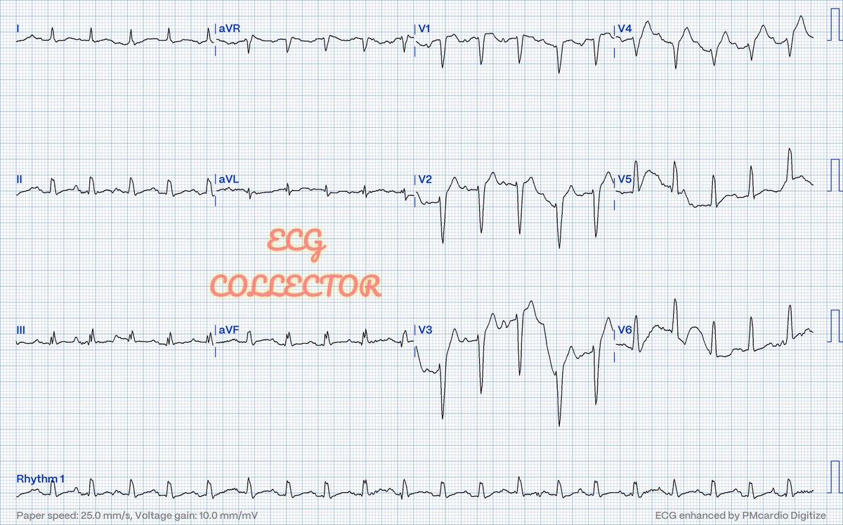 DrRazi4's tweet image. 64 y.o male DM; HTN acute onset chest heaviness and SOB; BP 175/105mmHg; PR 130bpm; Lungs - rhonchi; generalized crepitations bilaterally; Trop T&amp;lt;40.

What do you think❓🚑
@PMcardioBot @drharikrishrau @ainanabilaazhar @Eugene4463 
#ECG #ecg
#ecgchallenge 
#MedTwitter #MedX