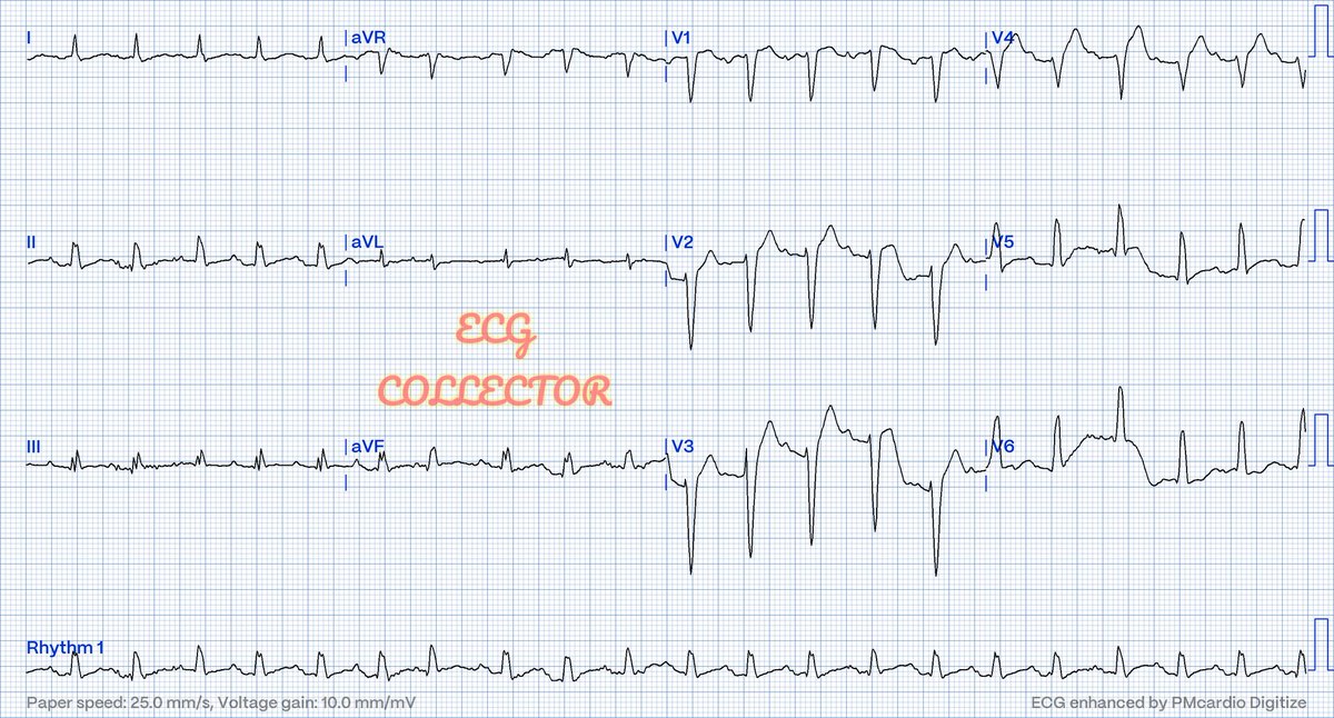 DrRazi4's tweet image. 64 y.o male DM; HTN acute onset chest heaviness and SOB; BP 175/105mmHg; PR 130bpm; Lungs - rhonchi; generalized crepitations bilaterally; Trop T&amp;lt;40.

What do you think❓🚑
@PMcardioBot @drharikrishrau @ainanabilaazhar @Eugene4463 
#ECG #ecg
#ecgchallenge 
#MedTwitter #MedX