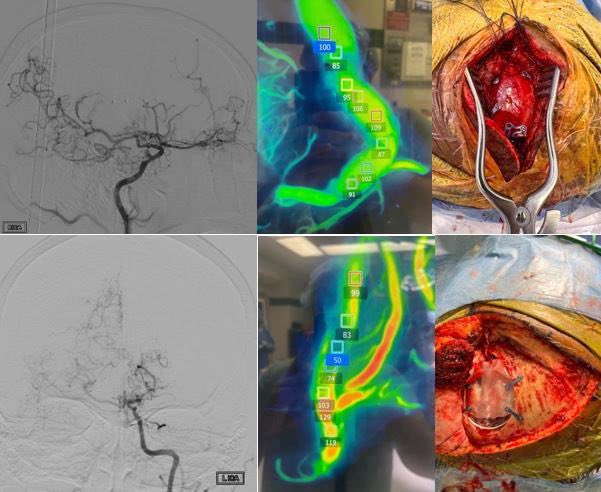 STA-MCA bypass for #moyamoya, 2 in 2 weeks @MedStarWHC @MGUHNeurosurg with #longevity implant and @ZEISSLenses Kinevo IR Flow 800. @CNS_Update #neurosurgery #bypass #MedEd