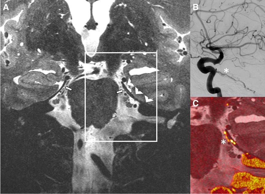 #StrokeImages Ultra-high resolution of #7TMRI could bring added value to the clinical management in dural arteriovenous fistulas. #DAVF #stroke #AHAJournals ahajrnls.org/42aYzDs