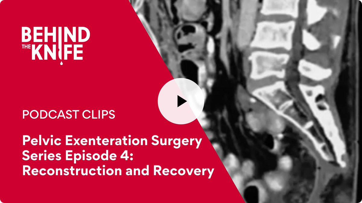 Pelvic Exenteration Surgery Series Ep 4 of 4: Reconstruction and Recovery - Don't miss it! 👏 @RPA_IAS @SOuRCe_RPA @KilianBrown3 @GabrielleVanRam @UGent @uzgent 🎧 app.behindtheknife.org/podcast/pelvic… 📺 app.behindtheknife.org/video/pelvic-e…