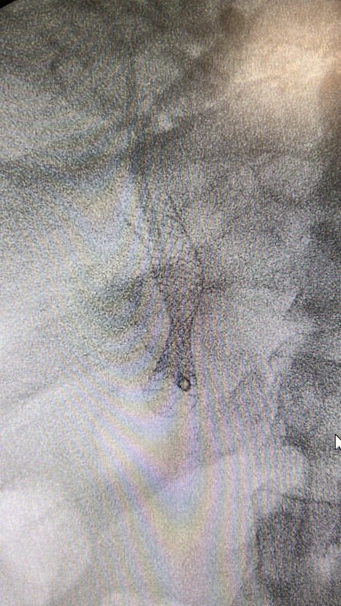 EUS-BD complication on Monday - distal axios flange deployed distal to BD; pulled catheter back to BD (stent now proximal to BD so axios lost), wire up to liver and following exchange placed 4fcsems &amp; plastic stent - patient doing very well with no symptoms