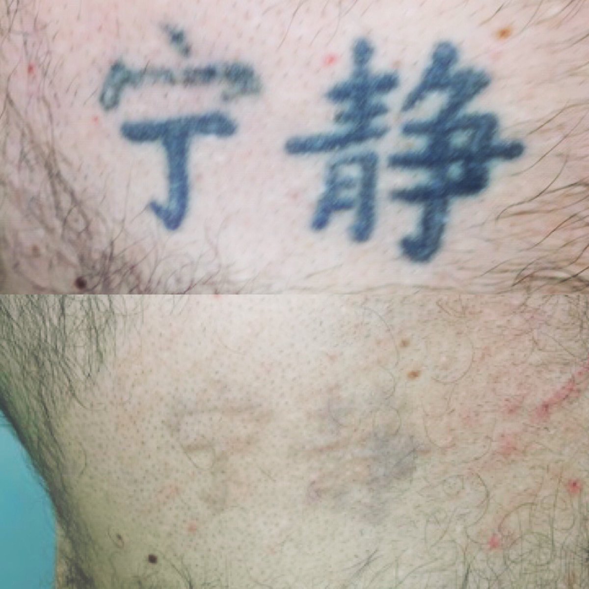 original_laser's tweet photo. After 8 laser treatments https://t.co/hW1bgfxpYO
