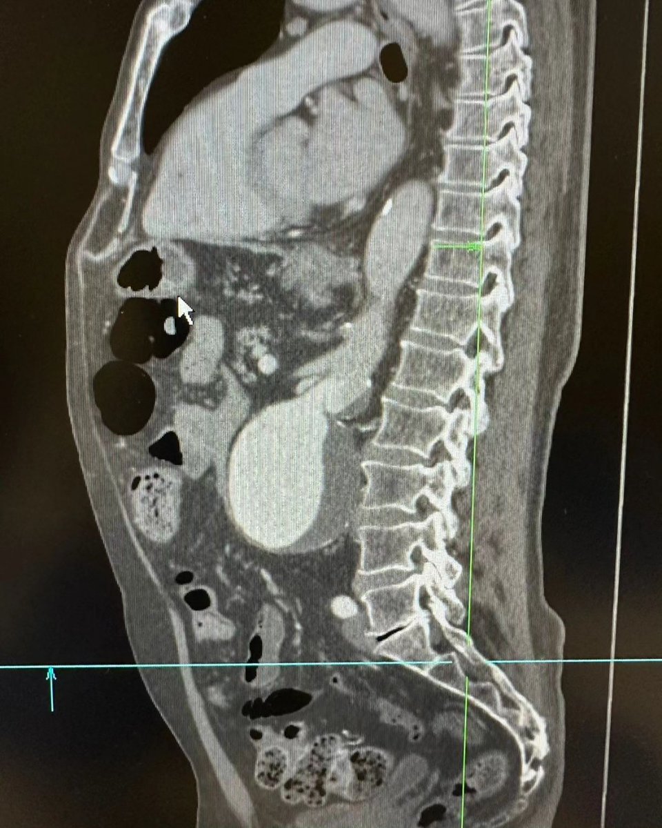 medicamex's tweet image. Resección Aneurisma de aorta abdominal Yuxtarrenal. Con interposición aorto-aortico de injerto de Dacron 18mm.

#Medicaldevices #dispositivosmédicos #Dacron #injertos