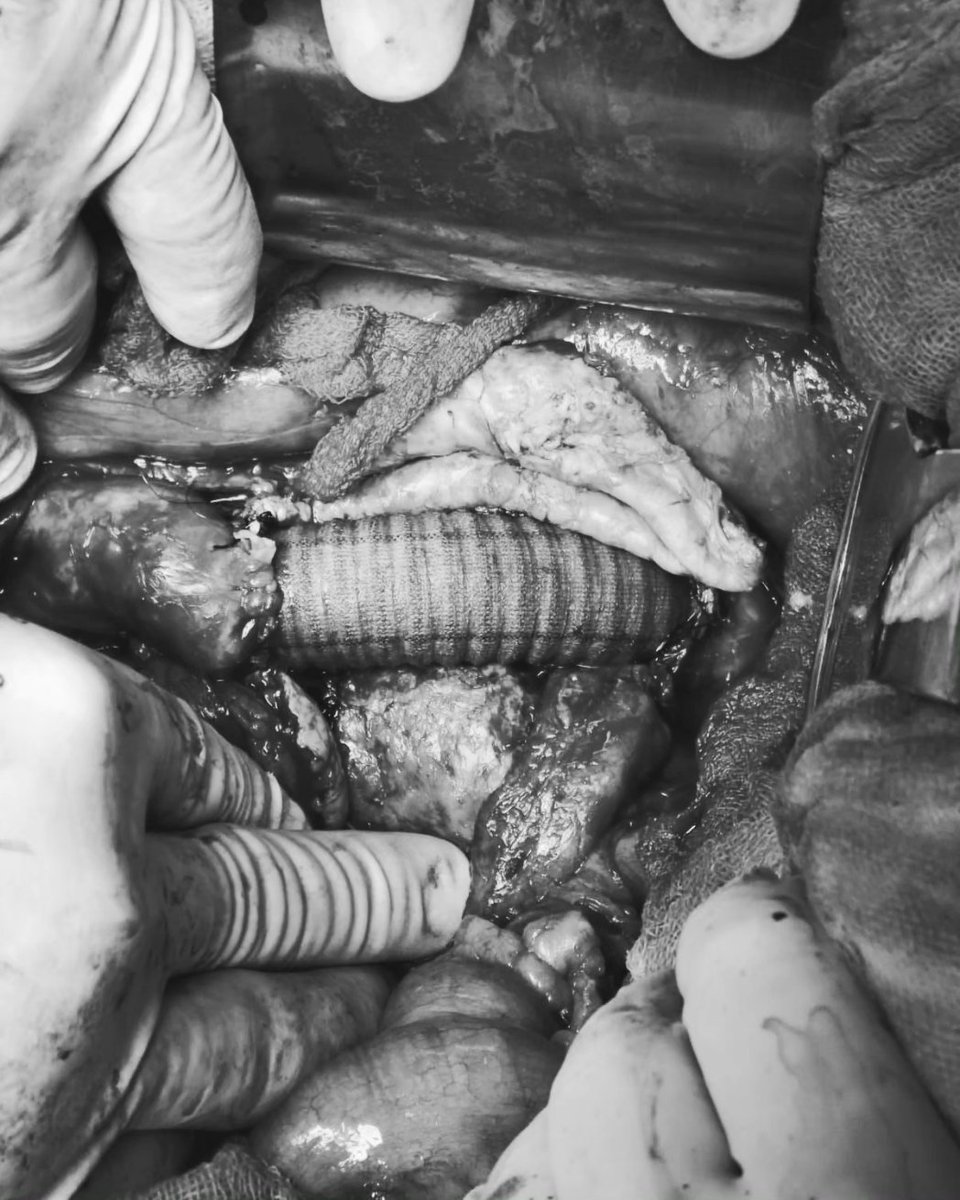 medicamex's tweet image. Resección Aneurisma de aorta abdominal Yuxtarrenal. Con interposición aorto-aortico de injerto de Dacron 18mm.

#Medicaldevices #dispositivosmédicos #Dacron #injertos