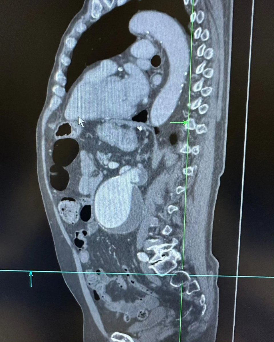 medicamex's tweet image. Resección Aneurisma de aorta abdominal Yuxtarrenal. Con interposición aorto-aortico de injerto de Dacron 18mm.

#Medicaldevices #dispositivosmédicos #Dacron #injertos