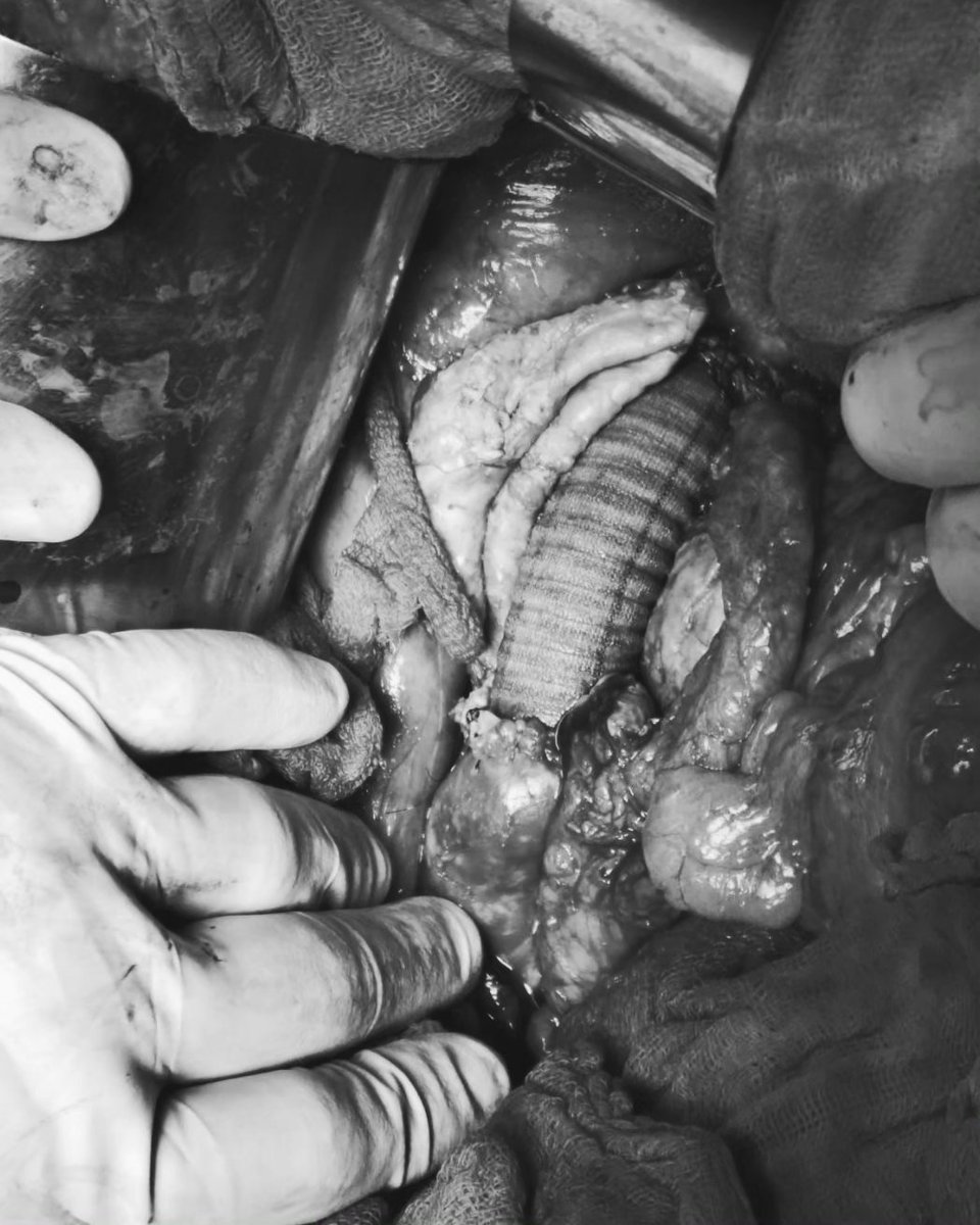 medicamex's tweet image. Resección Aneurisma de aorta abdominal Yuxtarrenal. Con interposición aorto-aortico de injerto de Dacron 18mm.

#Medicaldevices #dispositivosmédicos #Dacron #injertos