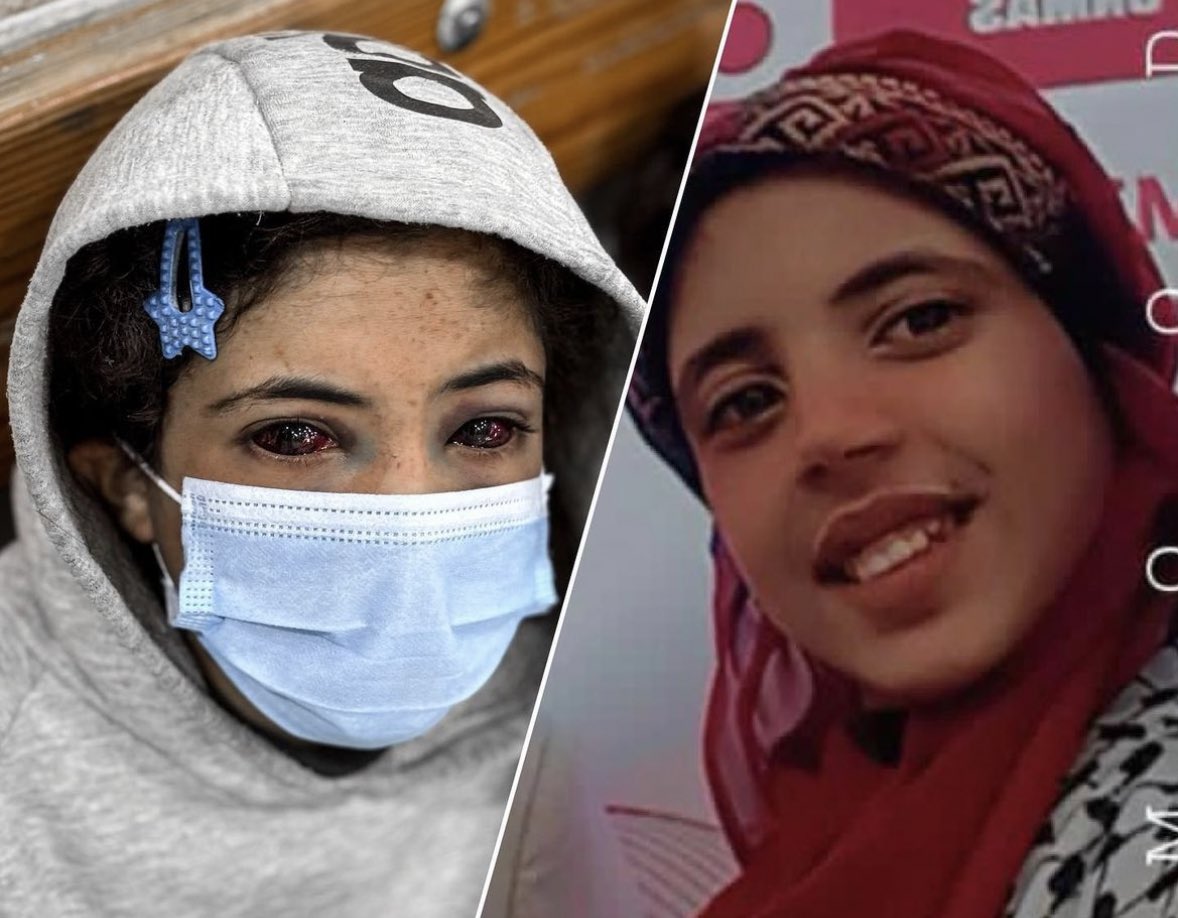 missfalsteenia's tweet photo. To the right is what Amina looked like before by the way. Israel did this to her. A 13 year old girl. https://t.co/fFRw8CSYrt