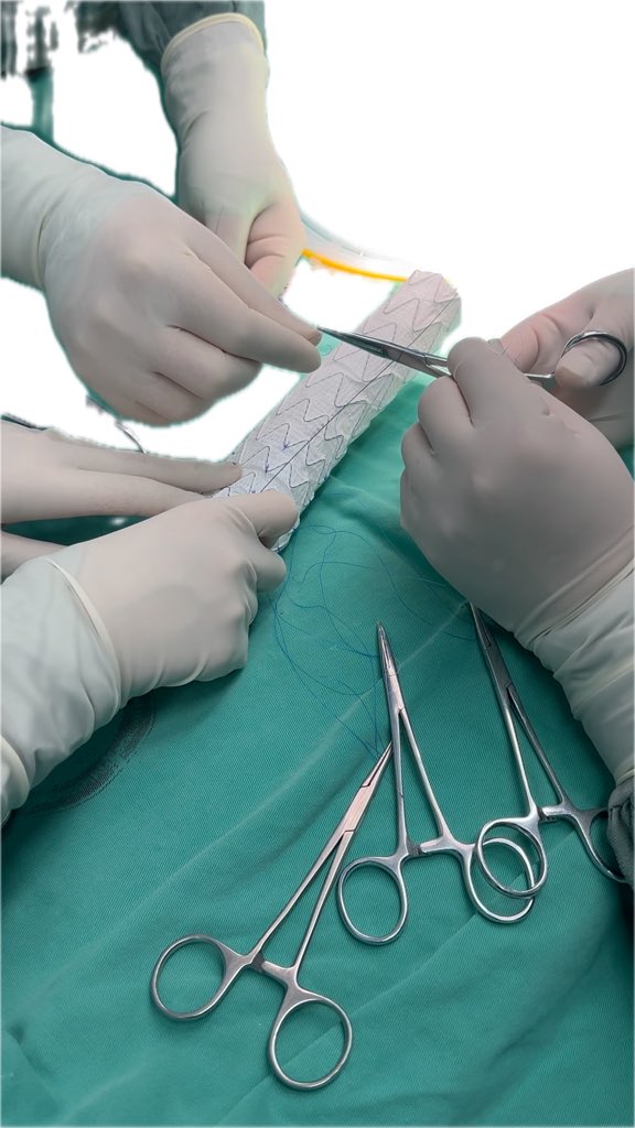 Learning physician modified endograft (PMEG) in China; 3v backtable fen for the arch. Neat tricks for diameter reducing ties. Helps in a pinch #aortaed #vascsurg #vascular #surgery #MedTwitter #dissection