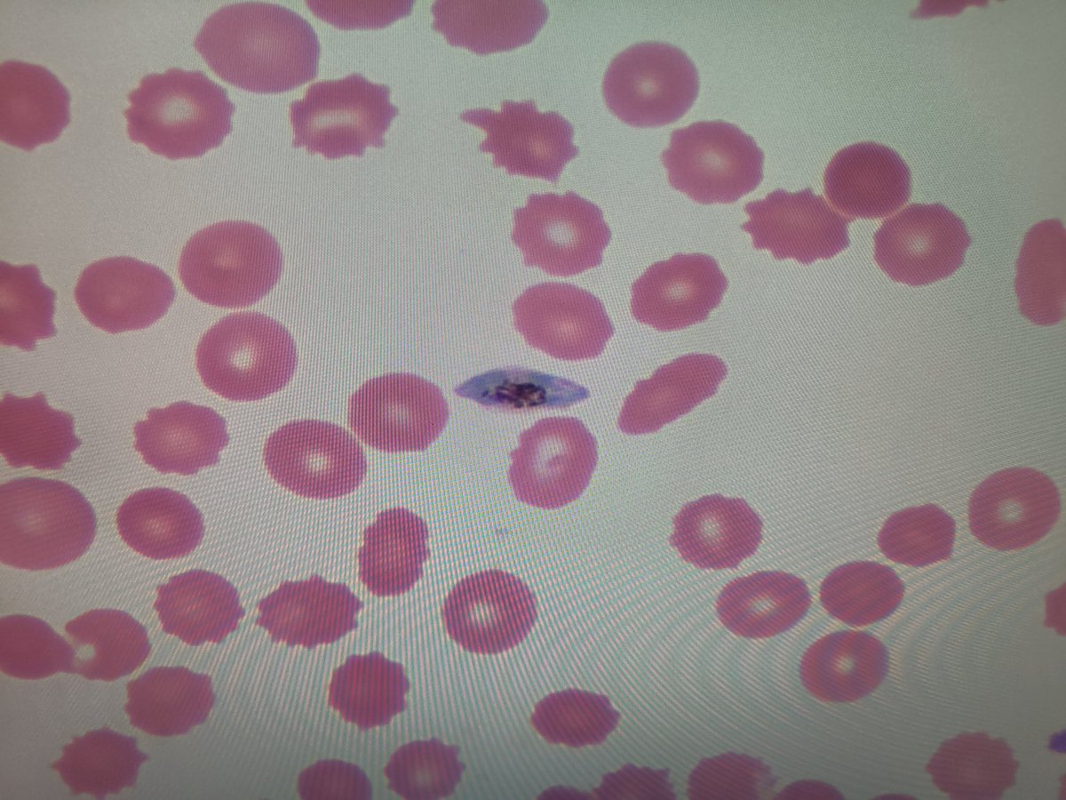 Plasmodium falciparum gametocyte 
#malaria
#MedTwitter
#hemepath