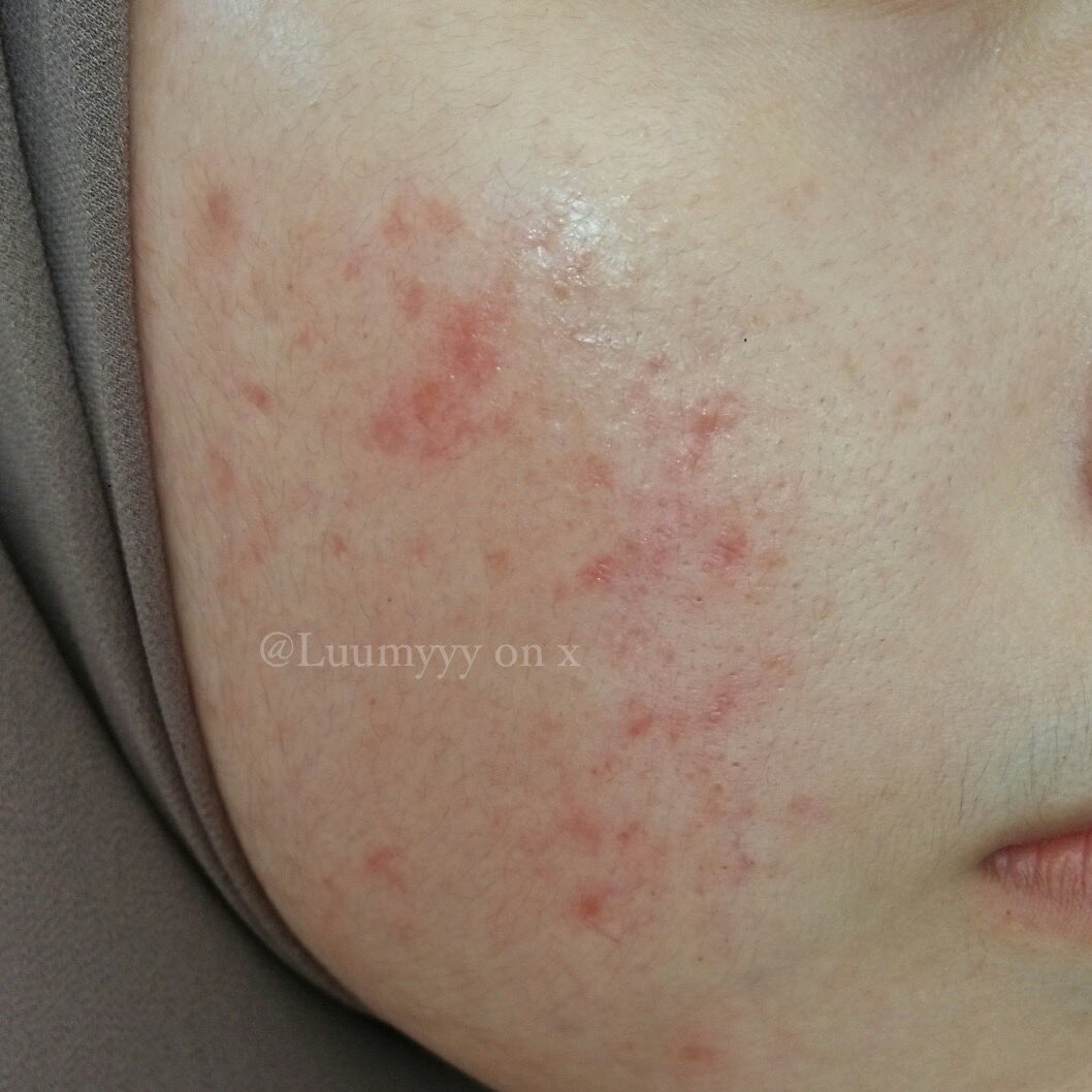 Luumyyy's tweet photo. •My Acne Journey🥺💫

Aku mau share rangkaian skincare yg aku pake dan cocok di aku, mulai dari basic skincare - active ingredients skincare.

A Thread👇🏻 https://t.co/HZXSzP6IyJ