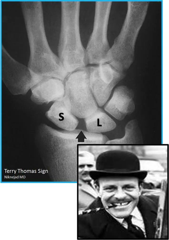 radRounds's tweet photo. What sign is this and what diagnosis does this support? https://t.co/Yy2r3sG4pk