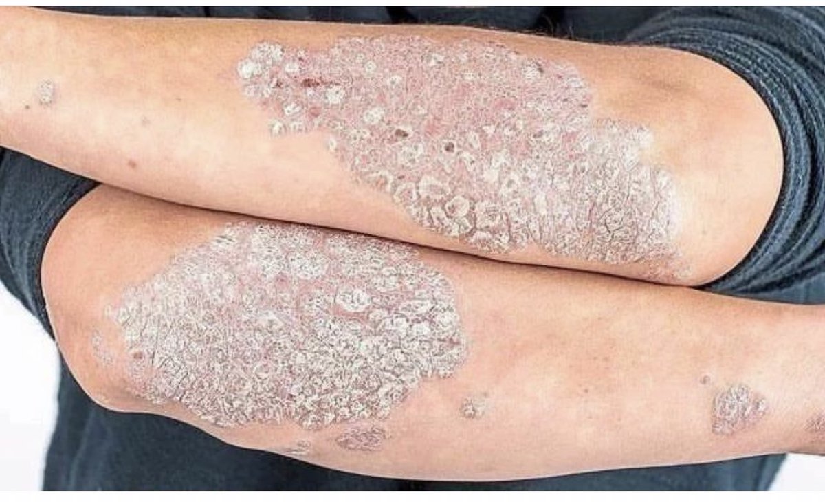 DrMedica_13's tweet photo. Clinical Challenge✨
.
“What is this #Disease?”
#Dignosis #DermaMed
#MedEd https://t.co/e98lUR5YUX