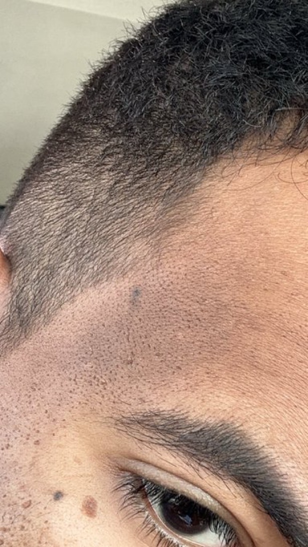 #تساؤلات | انا رجال وعندي تصبغات مع الجبهه وتعبت ما خليت شي ما سويت فراشكينال ليزر تقشير كيميائي ما فاد بشي ابد طالع لي زي الحرق ابي حل 🥲💔