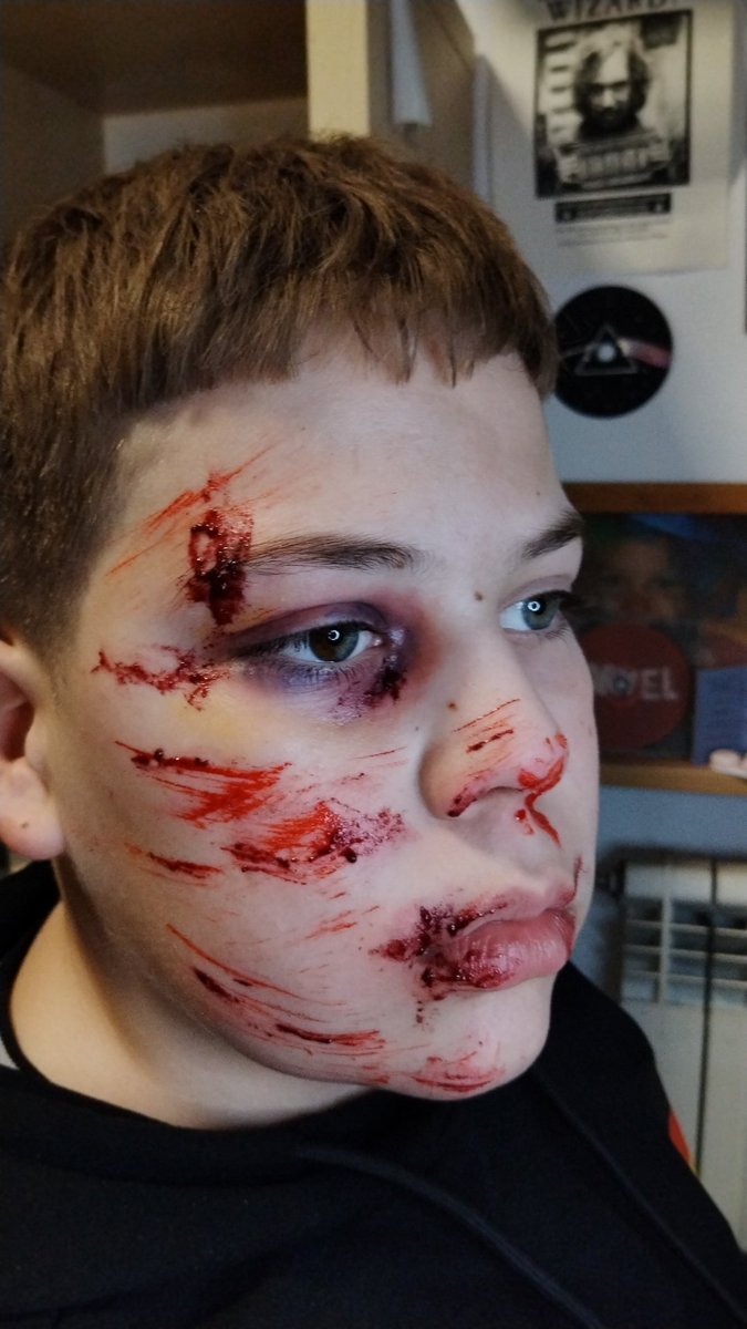 ❗FAKE MAKEUP❗
•
•
•
#sfx #sfxmakeup #Cinema #art #artist #special #specialeffects #fx #makeup #fake #wound #Blood #carcrash #fakemakeup