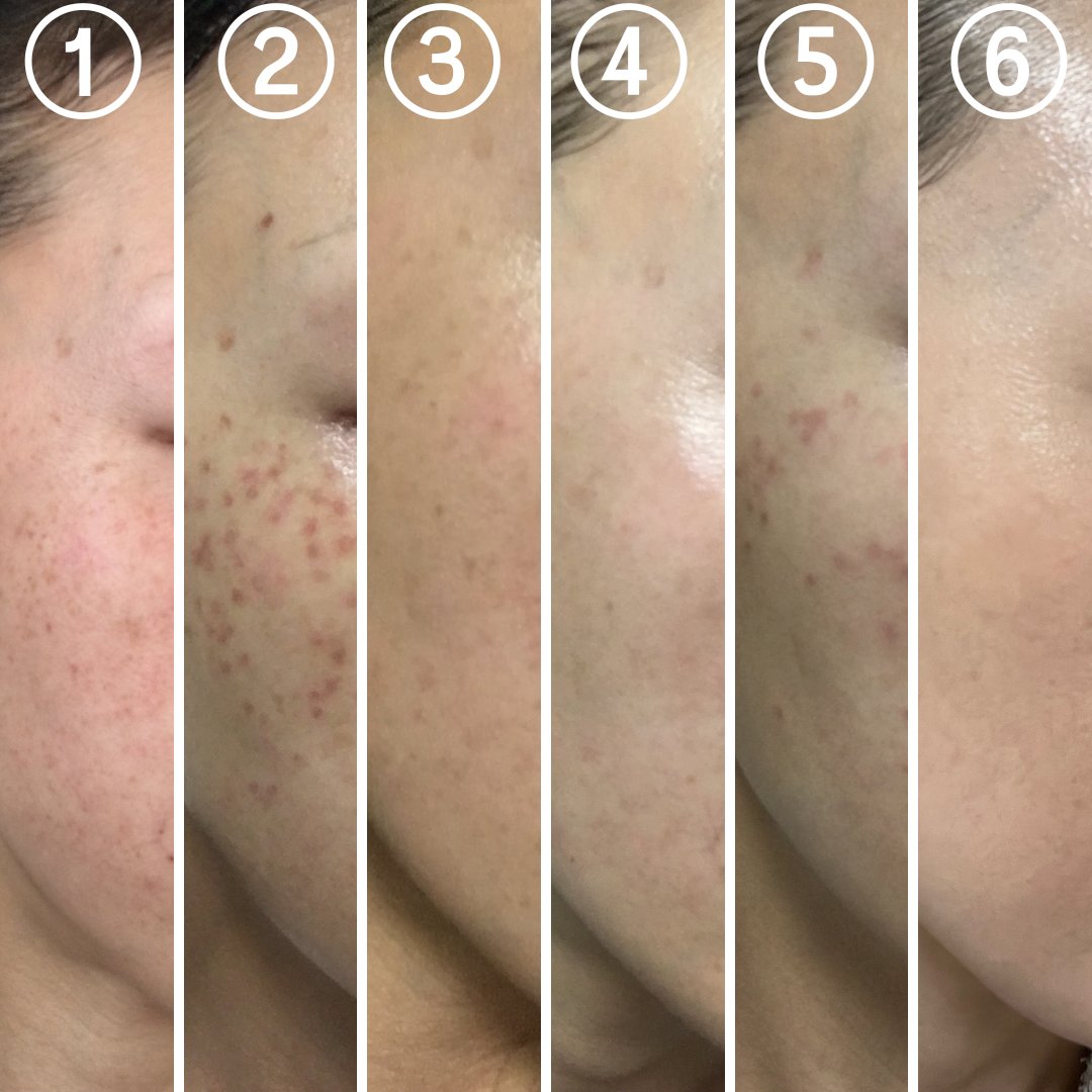 bikanbiyori_'s tweet image. ピコスポット2回
ピコトーニング18回
ヤグトーニング23回
IPL4回
水光注射7回
ダーマペン5回

がこの肌になれた主な治療。肌の土台を変えるって本当に大事。