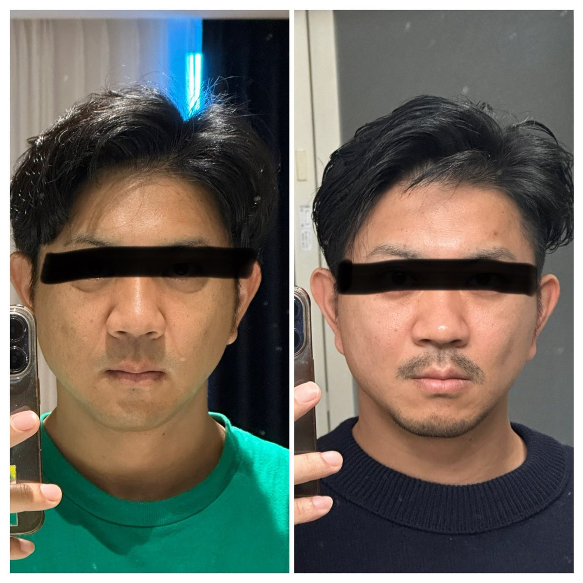 切開リフトからほぼ4ヶ月経過
耳たぶの感覚は8割かな

やっぱり小顔になった？？
仕上がりは満足です。

#rex 
#切開リフト 
#バッカルファット 
#メーラーファット
#整形垢 
#韓国 
#整形
#ANA
#voco
#ダウンタイム
#メンズ美容
＃ほうれい線