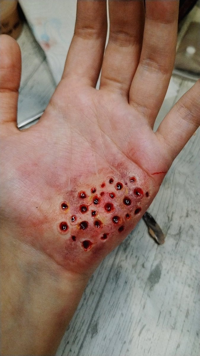 ❗ TRYPOPHOBIA ❗
•
•
•
#sfx #sfxmakeup #Cinema #art #artist #special #specialeffects #fx #makeup #fake #wound #Blood #carcrash #fakemakeup #fakewound
