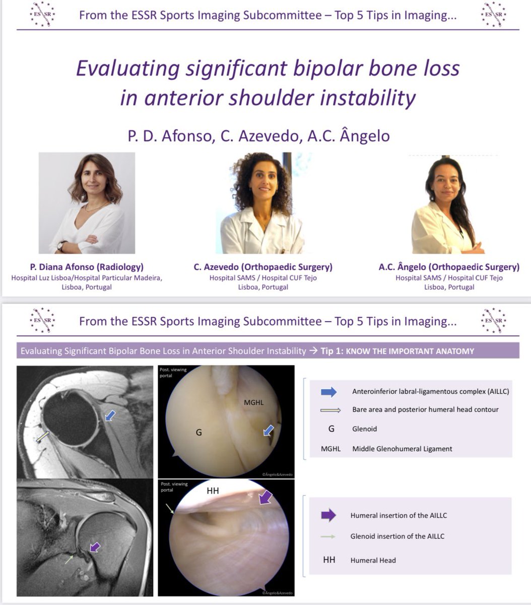 TOP 5 TIPS in Evaluating significant bipolar bone loss in anterior shoulder instability: essr.org/content-essr/u… By @Afonso1Diana and colleagues (from ESSR Sports Subcommittee)
