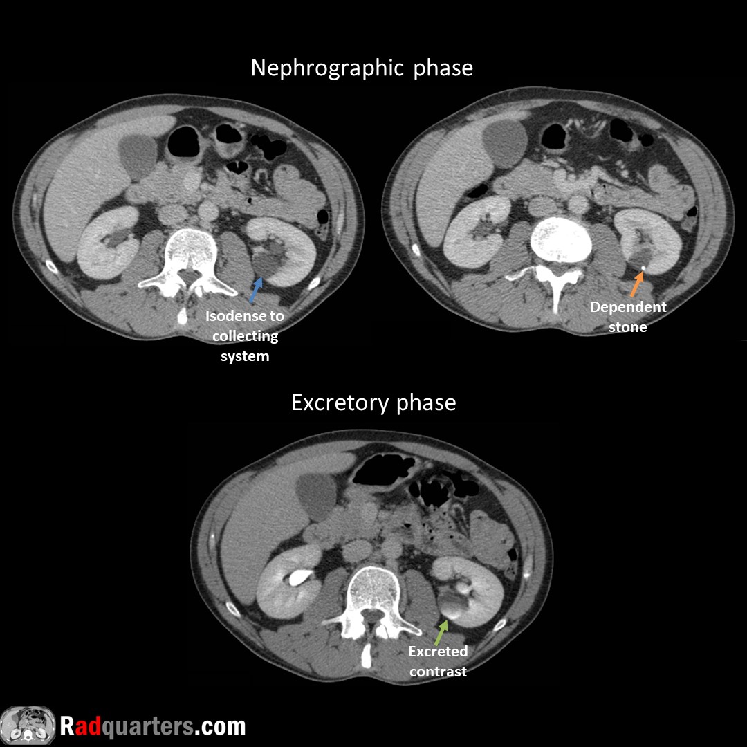 Calyceal diverticulum. Often asymptomatic. Can present with hematuria, stone formation or infection. Mimics cyst on conventional imaging, contains excreted contrast on excretory phase due to communication with collecting system. #FOAMrad #FOAMed #radres #medstudent #radquarters