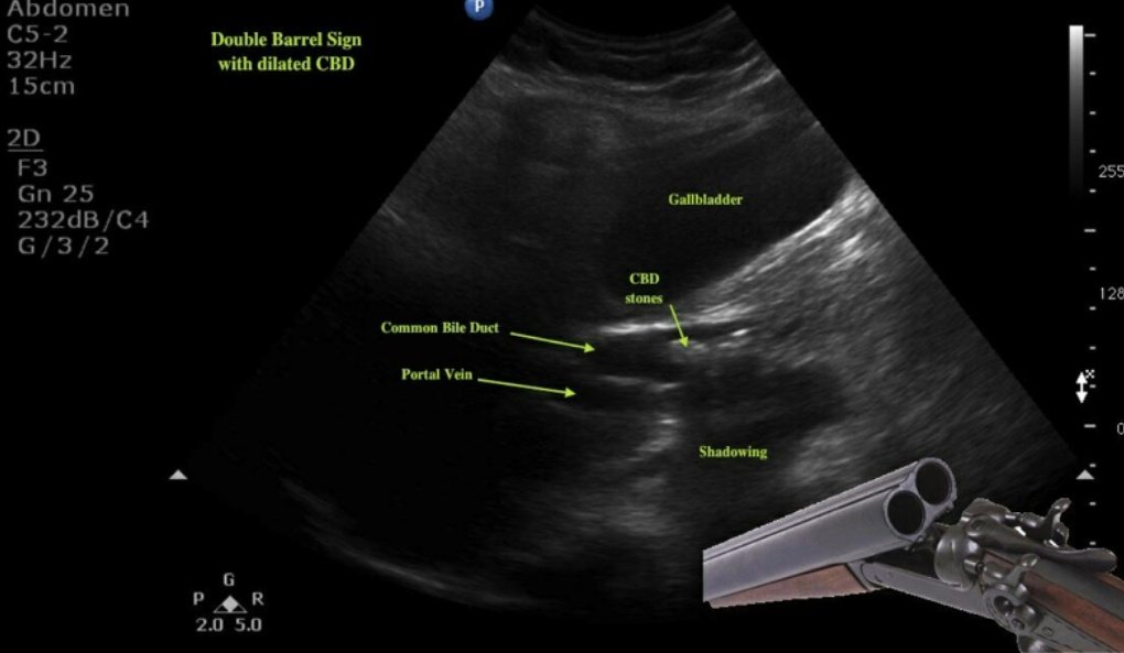 Let's explore the Doubles....#NEETPG #MedTwitter #MedX 

1) Double barrel shotgun sign- dilated CBD secondary to choledocholithiasis becomes comparable to Portal vein on USG