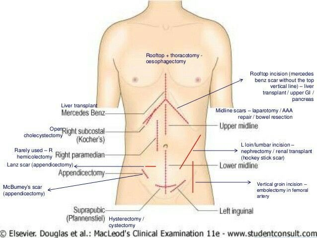 schowardjd's tweet photo. @Naeem_ch111 B. Liver transplant

Know your surgical scars 👇🏼

<source: https://t.co/OFZotrwZgM> https://t.co/LAVxOAsC4C